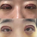 사람이소중한병원 | 부산 서면 돌출형눈 쌍수 절개 3개월차 리얼 후기 (+ 병원 정보)
