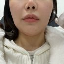 윤곽의정석성형외과의원 | 윤곽주사 내돈내산 후기｜갸름주사 브이핏주사 가격 효과 솔직 리뷰