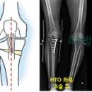 절골 수술[High tibial osteotomy] 이미지