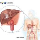 간색전술 과정 및 주의사항 (간암 , ) 이미지