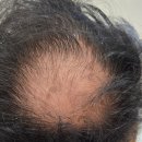 파라테라피 | 공릉 두피관리 내돈내산 후기｜파라테라피 두피스켈링 받고 달라진 변화 (비포&애프터)