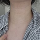 연세더아름의원 | 합정 연세보드미의원/편평사마귀 성지/얼굴,목 제거 후기