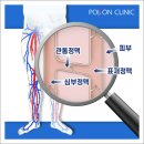 하지정맥류 증상, 어떻게 알고 확인할 수 있을까? 이미지
