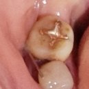 판교 최용훈치과의원 | [판교]최용훈치과 치아재식술-4편