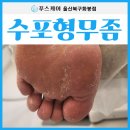 푸스케어울산북구화봉점 | 울산 북구 무좀 땀 많은 발 각질 관리의 정석 보여드립니다.