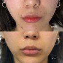 별이랑청담신경과의원 | 청담 쥬베룩 미라젯 피부과 / 2주차 찐후기 효과