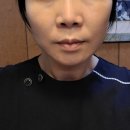 실 - 아산시 번영로217번길 28-3 | 위례 피부과 심부볼 실리프팅 후기 - 전 후 변화 비교