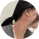 야탑 밴스의원 | [공지] 경기 : 성남 야탑역 새로 오픈한 ㅣ야탑밴스의원ㅣ목 편평사마귀 제거 비용, 제모 솔직 후기