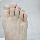 아나파의원 | 남양주내성발톱 닥터아나파문제성발톱클리닉 병원 안 발 클리닉 꼼꼼관리 후기