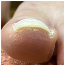 NP케어부산센텀점 네이버블로그