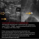 Zenker diverticula 이미지