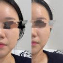 부산진구 동의대역 우아한하루에서 얼굴경락,환골수기윤곽술 관리받은 후기