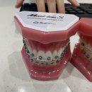 미소인치과교정과치과의원 | 서울클리어치과교정과치과의원 평택고덕, 교정1일차 후기, 평택 고덕 치과, 교정 전문 치과, 충치 치료