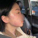 에스마리의원 | [울산 남구 피부과] 브이로리프팅 2번째 후기 !!!