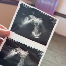 (주)태위 | 미국 산부인과 🇺🇸 : GBS 테스트 + 태아 자세 확인 초음파 + 요즘 겪는 증상 [임신 36주]