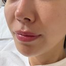 용인피부과 트리니티리프토닝 내돈내산 후기!