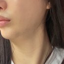 유니테라피 | [광화문 피부과] 튠유니페이스 + 산소테라피 효과, 후기