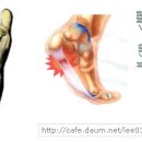 족저 근막염 (Plantar Fasciitis) --잘못된 정보 고치기 이미지