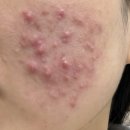 탄탄약국 | 여드름인 줄 알았는데 모낭염? 약국 에스로반 연고 사용법과 후기