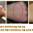 스킨트리 이미지