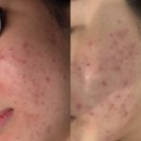 동탄오산피부샵 트러블관리 & 물방울초음파 문제성피부 전문 여드름 관리::오기온스킨에스테틱 오산점