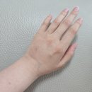 끼우자 | 양악후핀제거 수술 5일차~2주차 (붓기 변화, 실밥 제거) 유지장치가 이렇게 힘들 줄 몰랐어요..