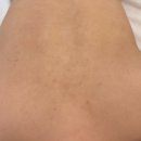 제이케어 | [원주] 원주 피부관리 매끈 등드름 관리 후기 “제이앤스킨케어”