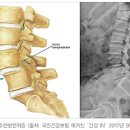 척추분리증 증상, 치료 (척추 4번 5번) 이미지
