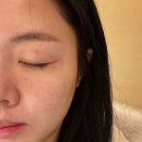 포항휴먼피부과의원 네이버블로그