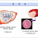 담관암 이미지