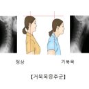 거북목 증후군 이미지