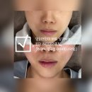 원레이져 | 예식 2주 전 관리로 선택한 압구정 에테르나의원 온다 레이저리프팅 후기