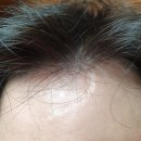 김영우성형외과의원 | 아들 이마의 교통사고 상처 수술 후기