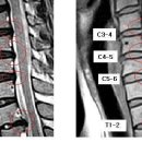 뭉게구름 님의 경추디스크 , T1-2 흉추디스크 mri 판독입니다. 이미지