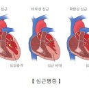 심장비대증, 확장성 심근병증 & 비후성 심근증 증상 및 치료 (호흡곤란) 이미지