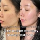 언덕위에늘푸른어린이집 | 대구 리투오 스킨부스터 전후비교 효과 통증까지 일주일 변화 솔직후기