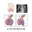 기관지폐 형성이상(Bronchopulmonary dysplasia) 소아청소년질환, 호흡기질환? 이미지