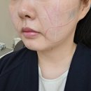 더라임호텔 | 강남역피부과 울쎄라피프라임 이중턱 관리 시작! 1차 상담 후기