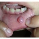 연세다나이비인후과의원 | 입 안 수포, 점액낭종 제거 수술 후기, 가격, 통증(여의도 뉴연세이비인후과)