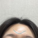 휴필라 | 이마필러 후 울퉁불퉁 뭉침 파임 짝짝이1일차 ~일주일 내돈내산 7cc 부작용 자세한 후기(+리터치)