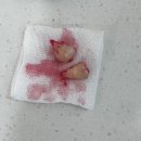 편한이치과의원 | 범계 턱편한사랑니치과의원 매복 사랑니 발치 후기