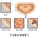 간질성 방광염(Interstitial Cystitis) 이미지