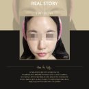 세진피부과의원 | [세진피부과] 거뭇거뭇 여드름색소침착 치료 후기