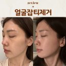 얼굴잡티제거 엑셀브이가격 후기 + 레블라이트
