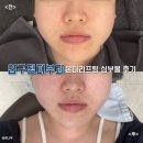 압구정길약국 | 압구정피부과 온다리프팅 심부볼 정리 후기