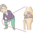 골절 후 부정 유합, 불유합 (Malunion & nonunion of fracture) 이미지