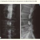 디스크, 하지방사통 쉽게 호전되지 않는 가장 큰 이유 lateral recess stenosis 치료법 이미지