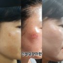 인셀덤꿈틀