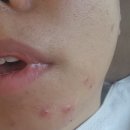 동탄호수공원 피부관리 더맑은스킨 MTS 관리 후기