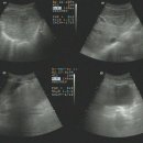 Rt. renal cyst 이미지